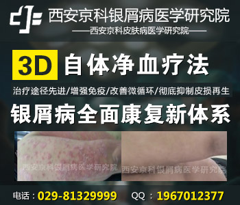 郑州哪里治疗牛皮癣最好 郑州哪里治疗牛皮癣最好